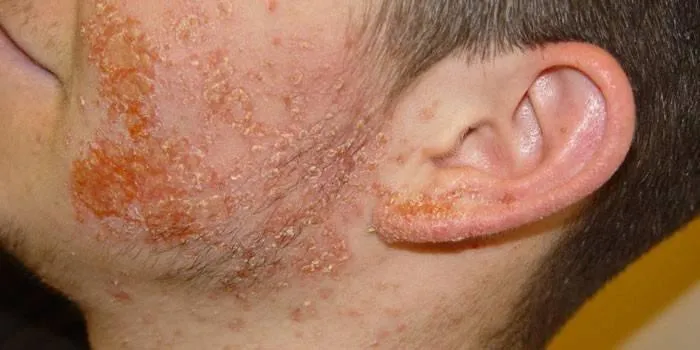 streptodermiia-u-doroslykh-symptomy-prychyny-ta-suchasne-likuvannia-c3bb