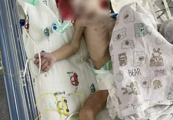 Виснажена двомісячна дитина в реанімаційному ліжку з апаратами
