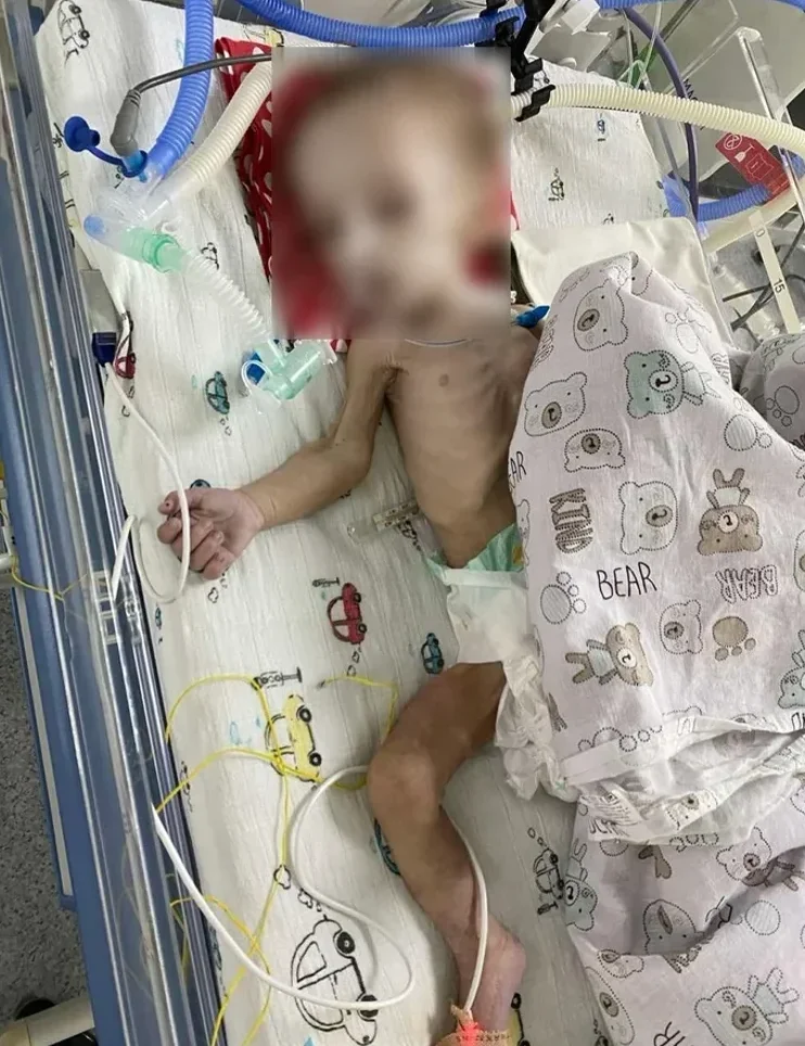 Виснажена двомісячна дитина в реанімаційному ліжку з апаратами